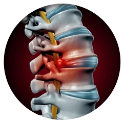 Chiropractic Allentown PA Disc Herniation Symptoms